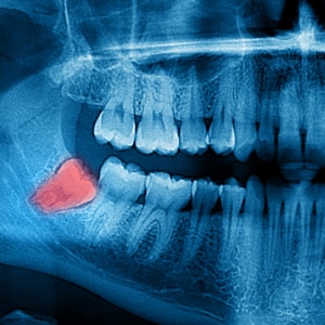 feature-img-wisdom-teeth