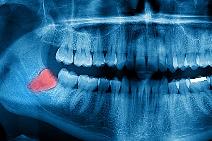 img-wisdom-teeth